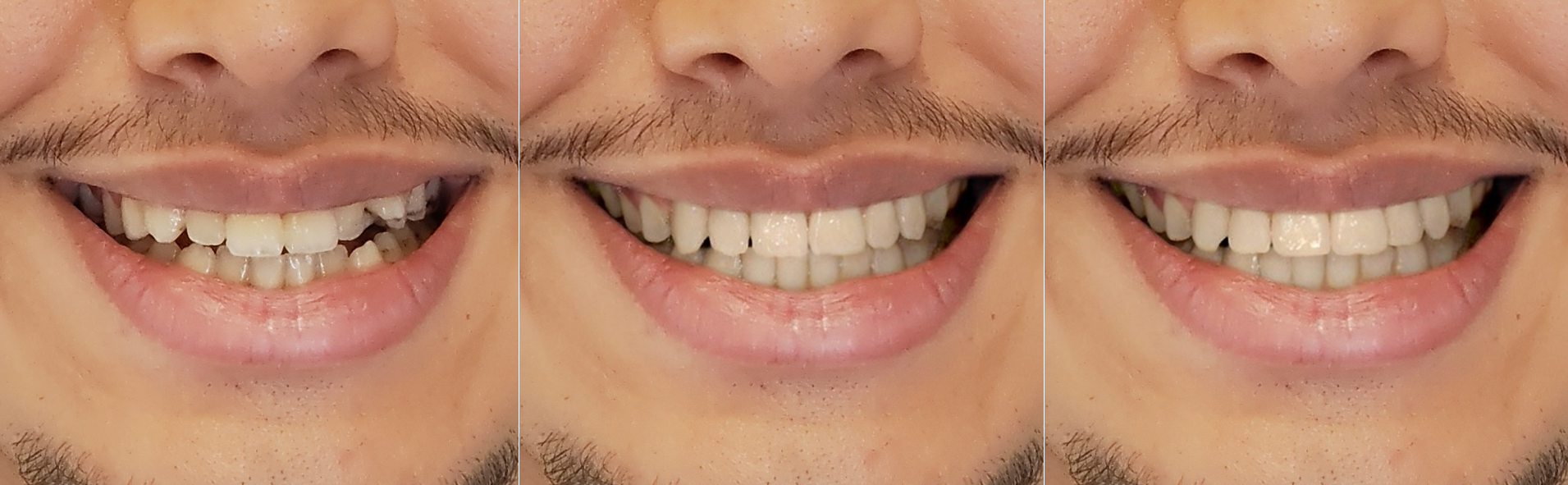 Tre bocche sorridenti, ciascuna con denti diversi: danneggiati, poi migliorati, infine perfettamente allineati e bianchi.