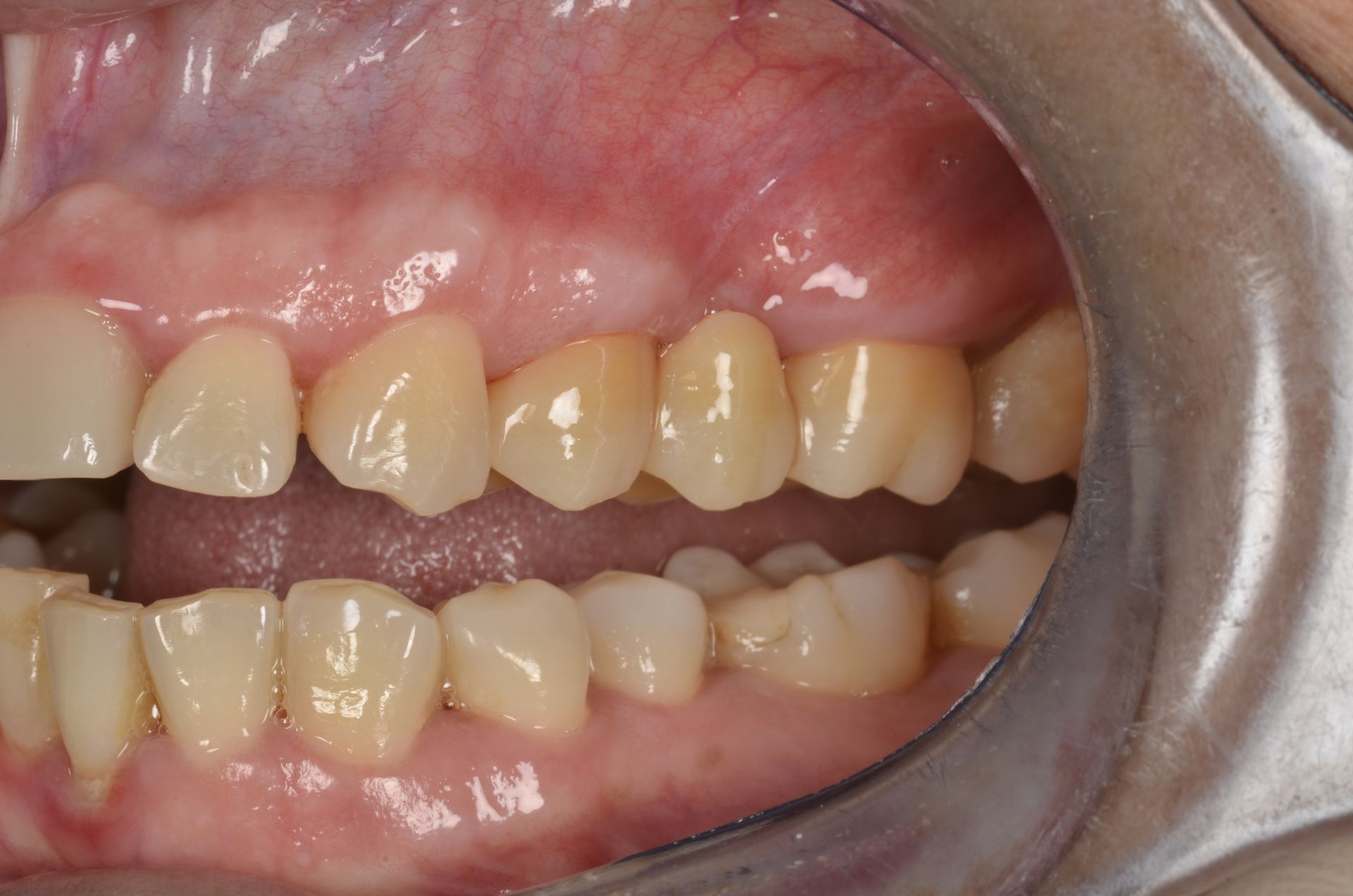 All'interno della bocca sono visibili i denti, alcuni dei quali otturati, e le gengive sono rosa.