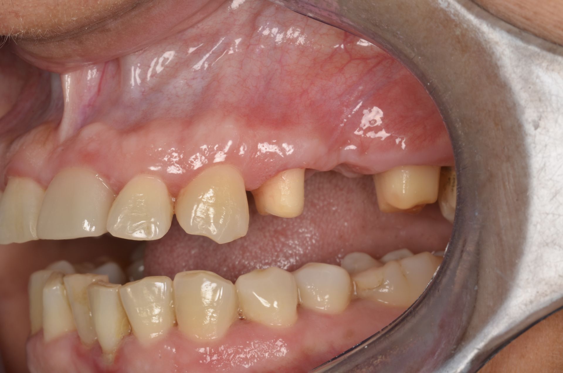 Bocca aperta, con denti mancanti o danneggiati. Gengiva leggermente infiammata. Sono visibili gli strumenti odontoiatrici.