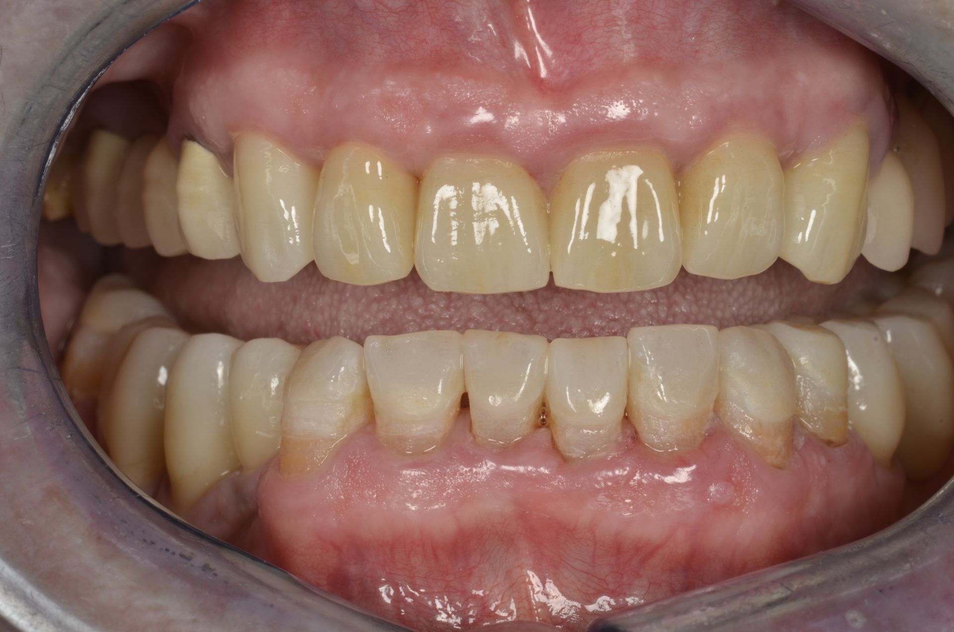 Primo piano dei denti di una persona, che mostrano le file superiore e inferiore, bianche con gengive leggermente ingiallite e rosa.