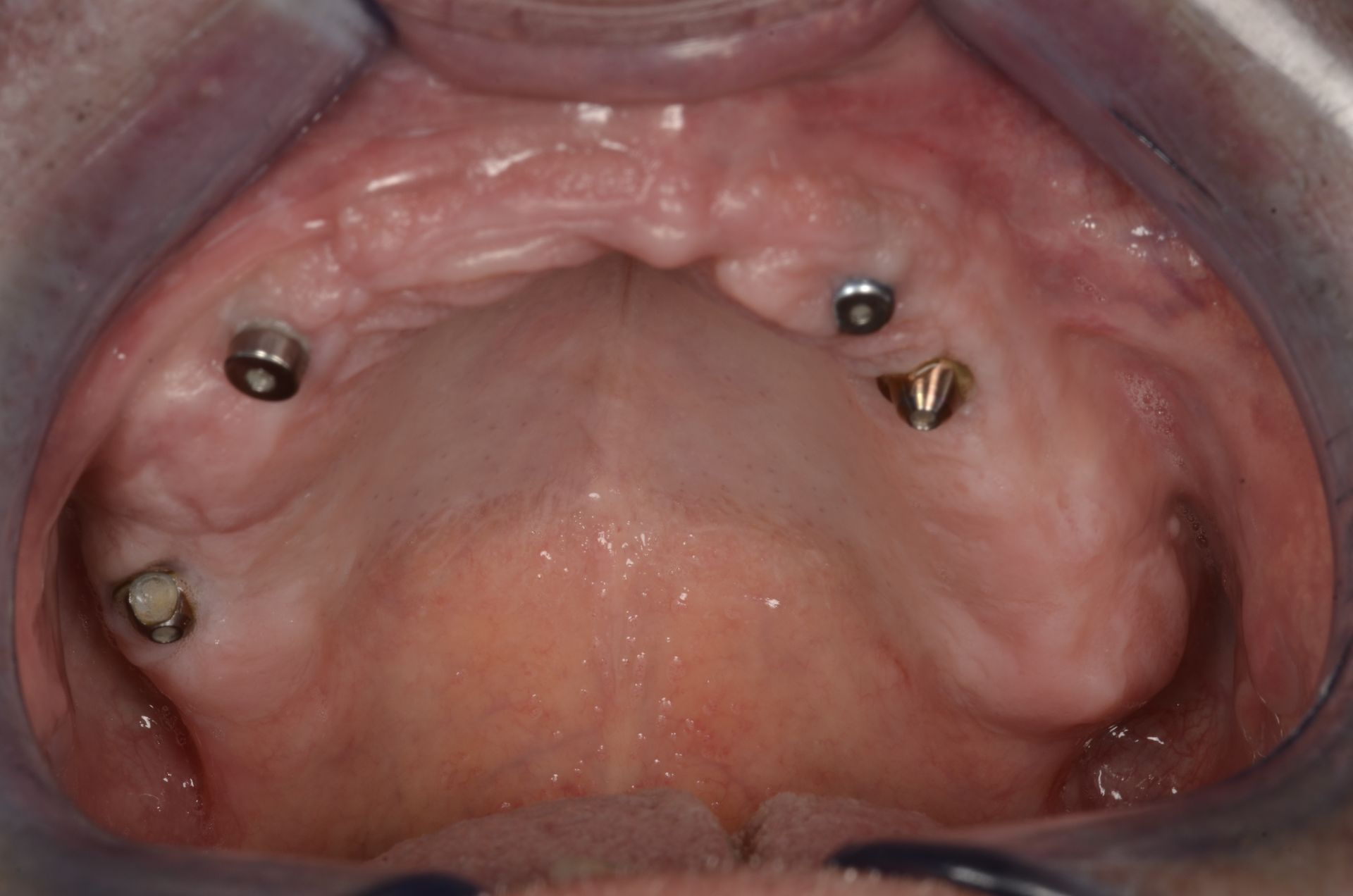 Bocca aperta con quattro impianti dentali visibili nella mascella superiore.