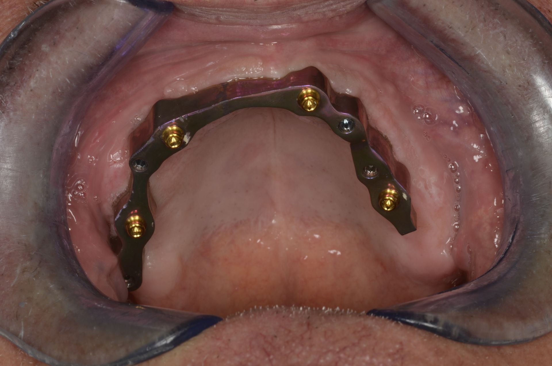 Struttura implantare dentale nella bocca di un paziente. Barra metallica con più perni fissati alla mascella superiore.