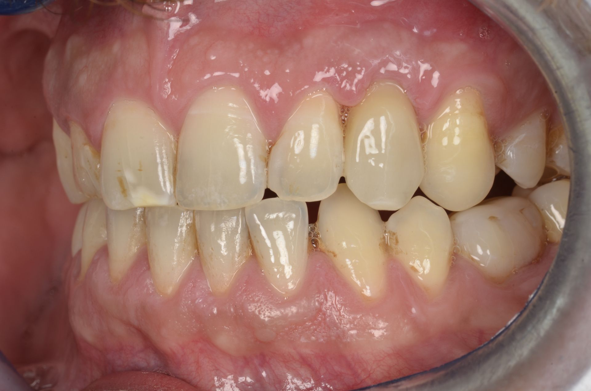 Primo piano dei denti di una persona, che mostra denti ingialliti con qualche macchia, gengive e un leggero disallineamento.