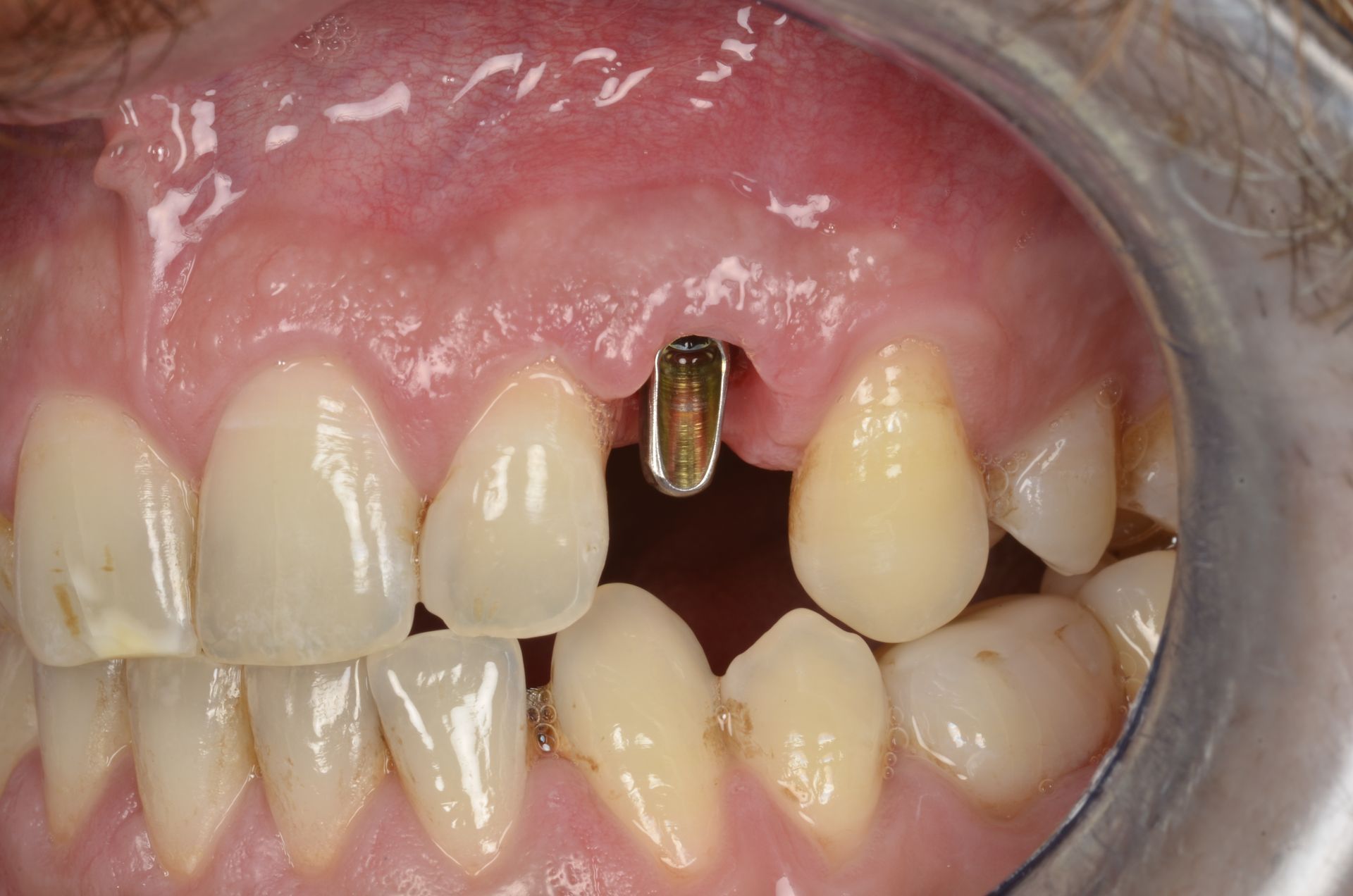 Primo piano di una bocca con un impianto dentale visibile. Sono presenti anche i denti circostanti, alcuni con corone.