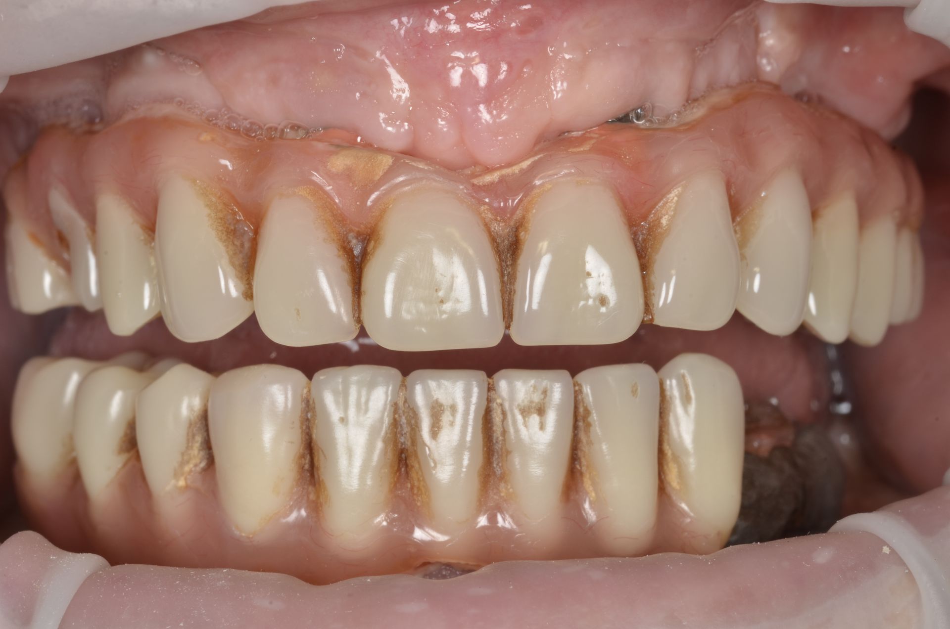 Primo piano della bocca di una persona con protesi superiore e inferiore macchiate. Gengive rosa, denti beige.