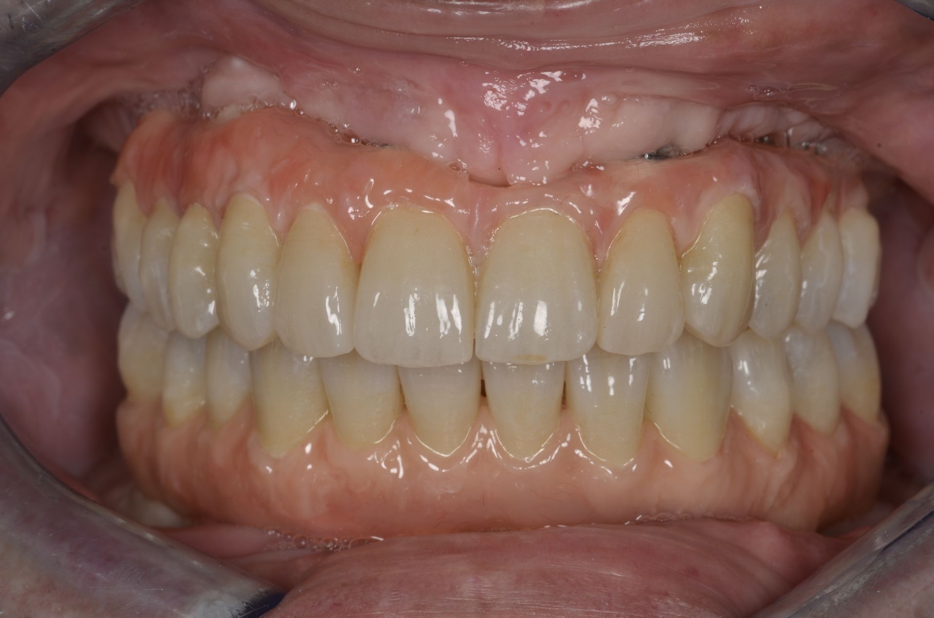 Primo piano della bocca di una persona con una dentatura artificiale completa. Le gengive sono rosa, i denti sono di colore chiaro.