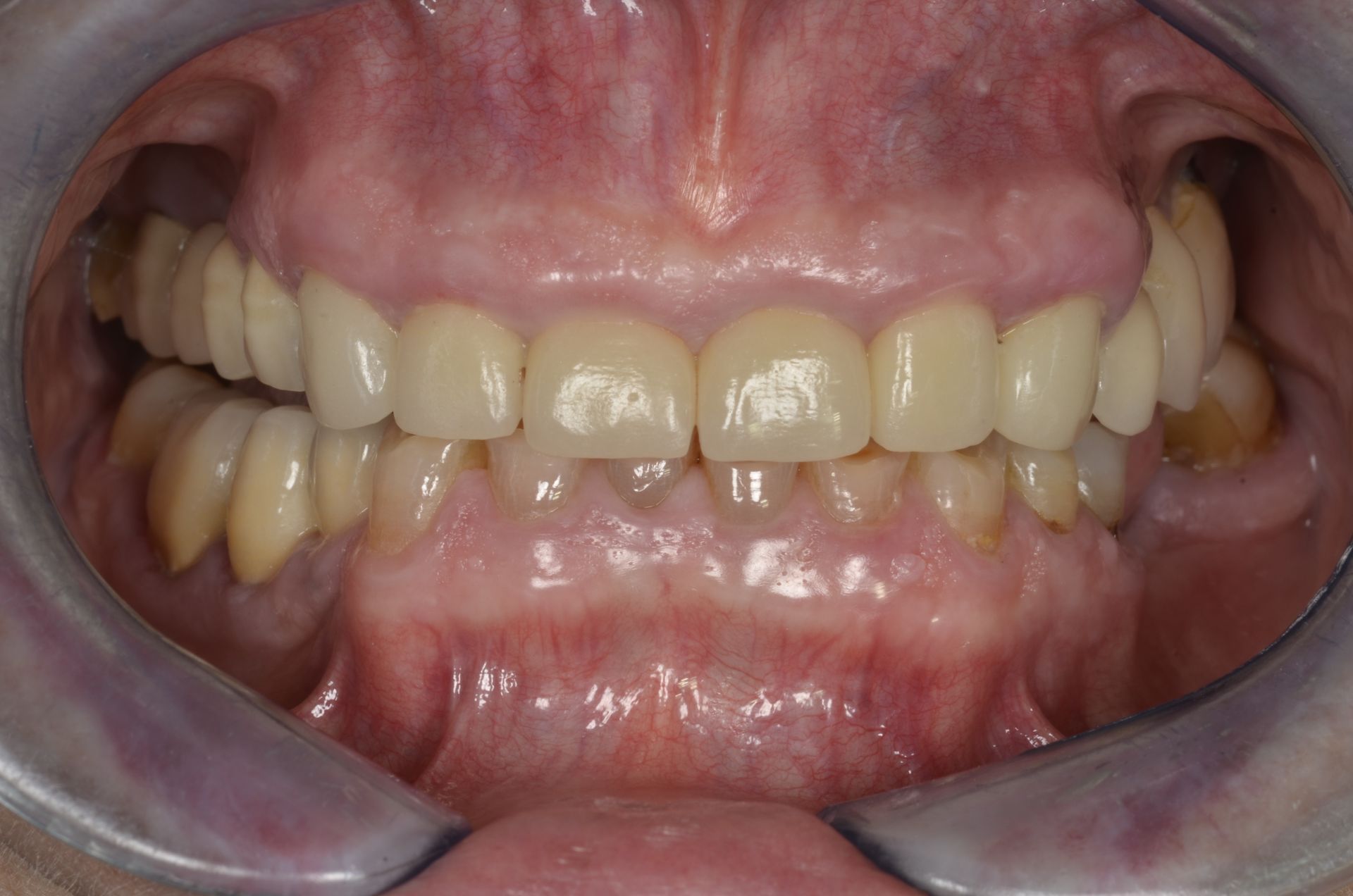 Primo piano della bocca di una persona, che mostra denti e gengive. I denti sono bianchi e leggermente ingialliti, con un leggero affollamento.