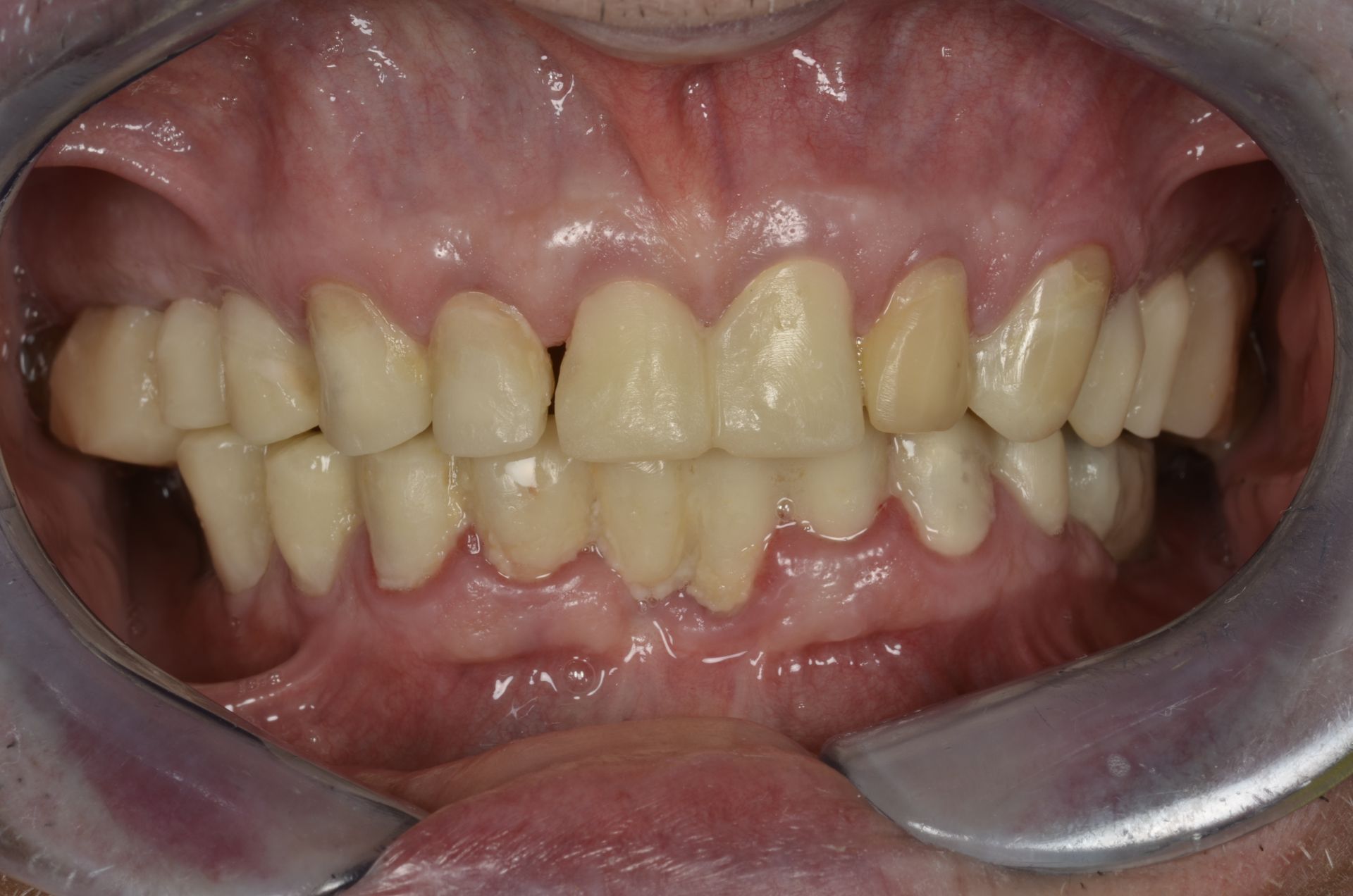 Vista aperta dei denti, che mostrano usura e scolorimento, con il retrattore dentale in posizione.