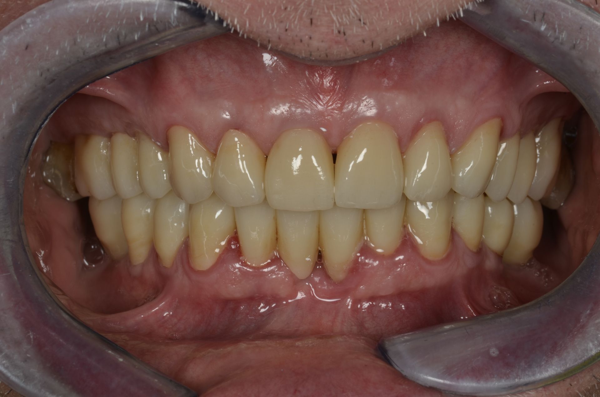 Una vista dentale che mostra i denti di una persona. Sono visibili i denti superiori e inferiori. I denti sono di colore bianco-giallastro e dall'aspetto sano.