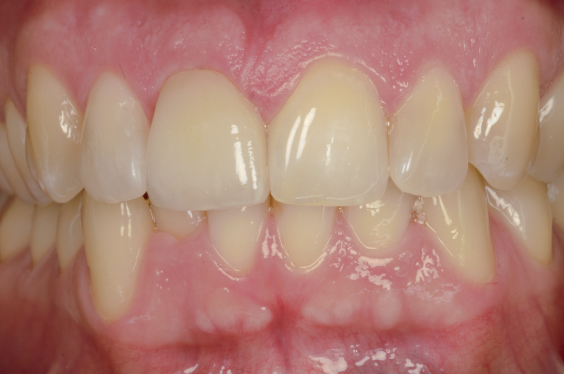 Primo piano dei denti di una persona. Denti bianchi con gengive rosa; lieve morso profondo.