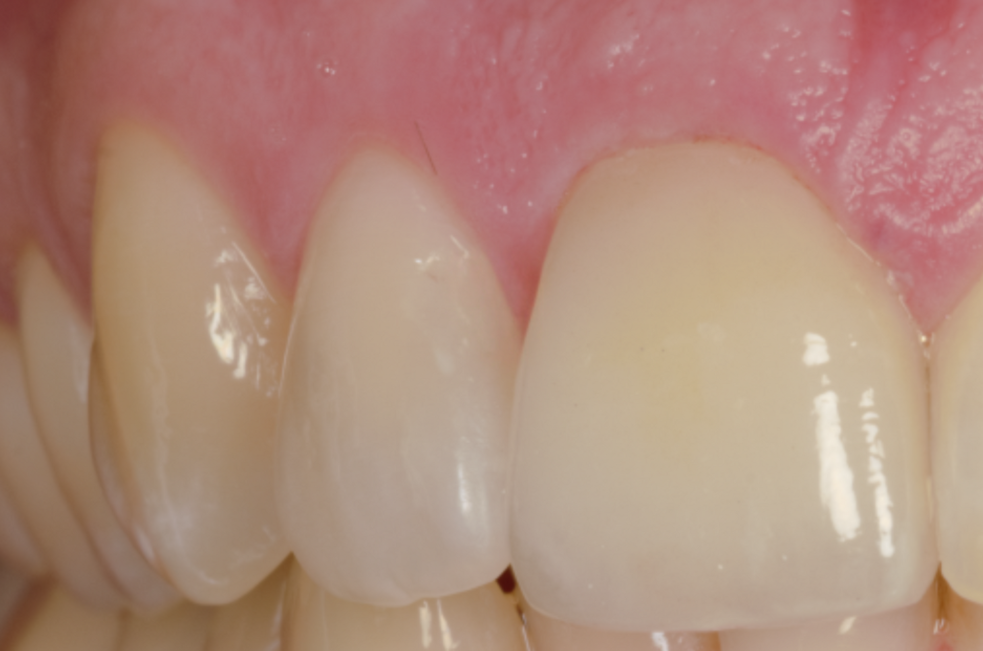 Primo piano di tre denti, uno con corona dentale, contro gengive rosa.