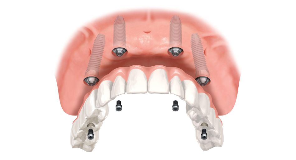 Schema degli impianti dentali che sostengono una protesi. Mostra mascelle superiore e inferiore, gengive rosa e dispositivi metallici.