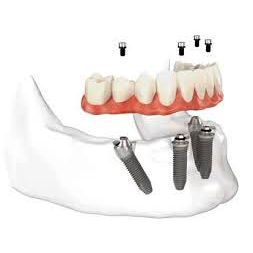 Illustrazione di una mascella inferiore con impianti dentali e una serie di denti artificiali.