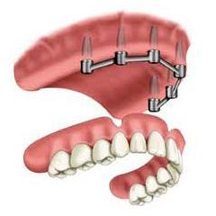 Schema delle protesi fissate agli impianti dentali nella mascella superiore e inferiore.