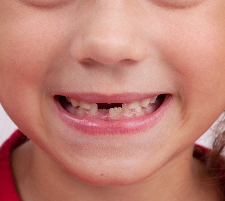Bambino sorridente, a cui mancano i denti anteriori.