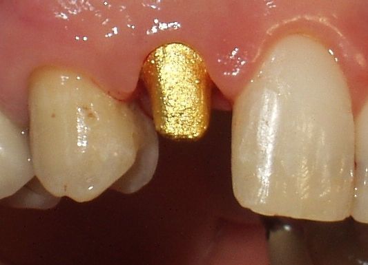 Primo piano di una bocca che mostra una corona dentale in oro tra due denti naturali.
