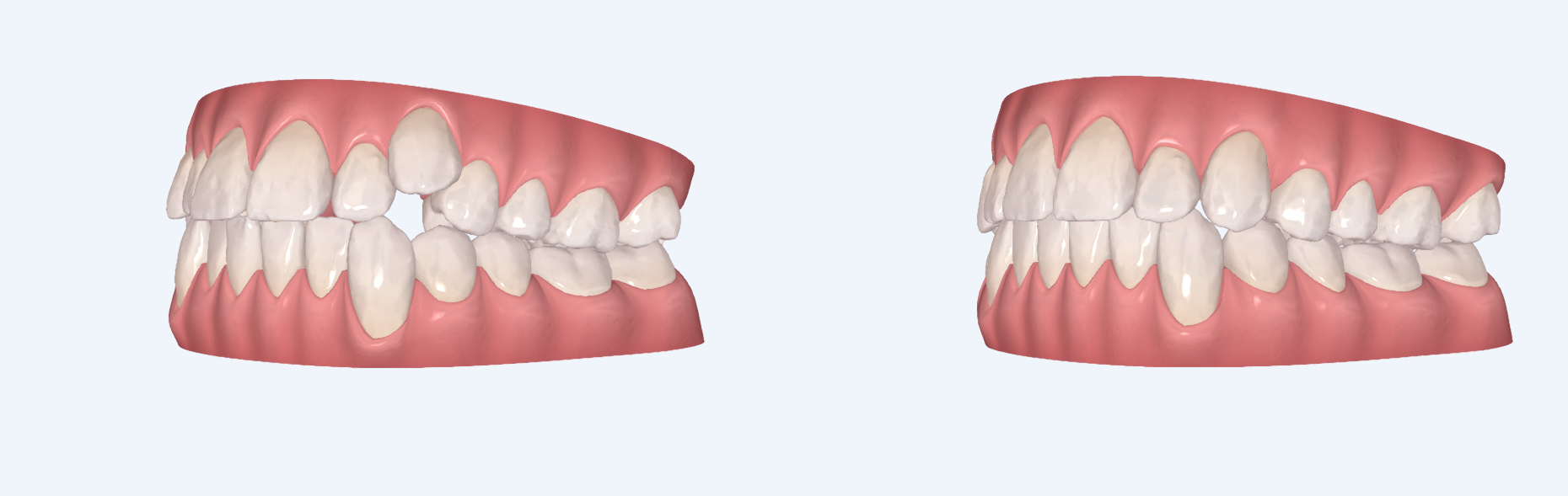 Denti prima e dopo il trattamento ortodontico. Denti bianchi su gengive rosa sono mostrati di profilo.