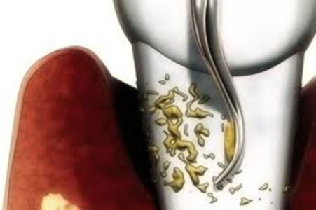 Illustrazione di una pulizia dentale: uno strumento dentale d'argento raschia la placca giallastra da un dente, circondato da gengive rossastre.