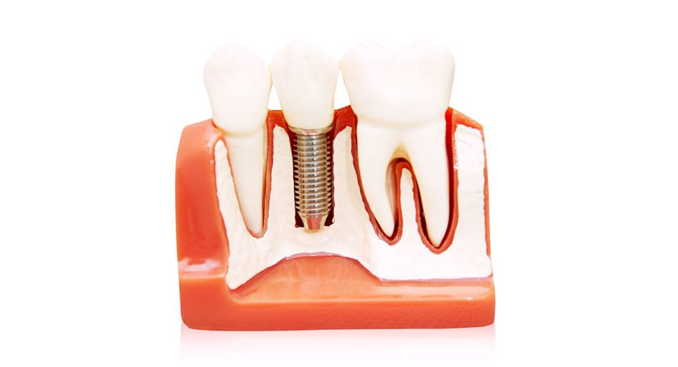 Modello di denti con impianto; mostra come è radicato nella mascella.