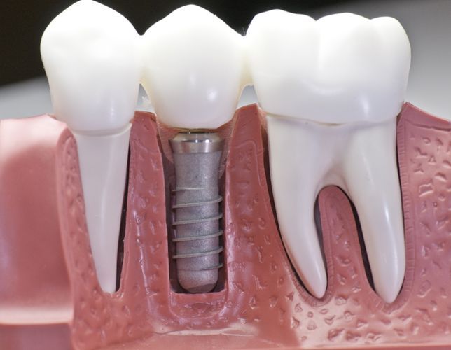Modello dentale che mostra un impianto dentale con gengive e denti circostanti.