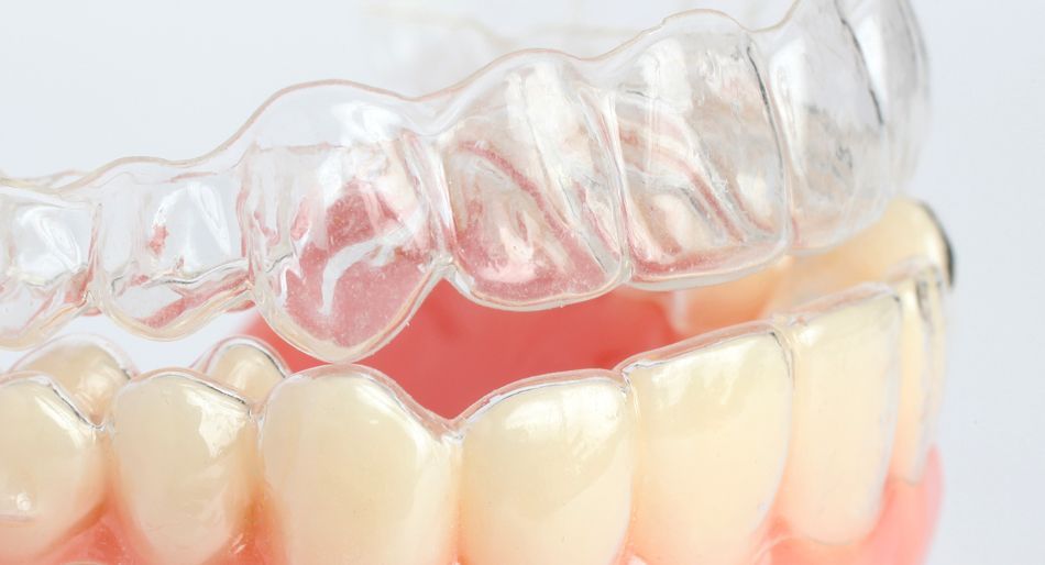 Allineatori trasparenti applicati su una serie di denti, probabilmente per un trattamento ortodontico.