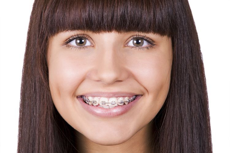 Donna sorridente con apparecchio ortodontico, capelli scuri e frangia.