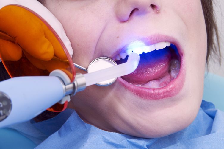 Un dentista utilizza la luce blu sui denti del paziente durante una procedura odontoiatrica.