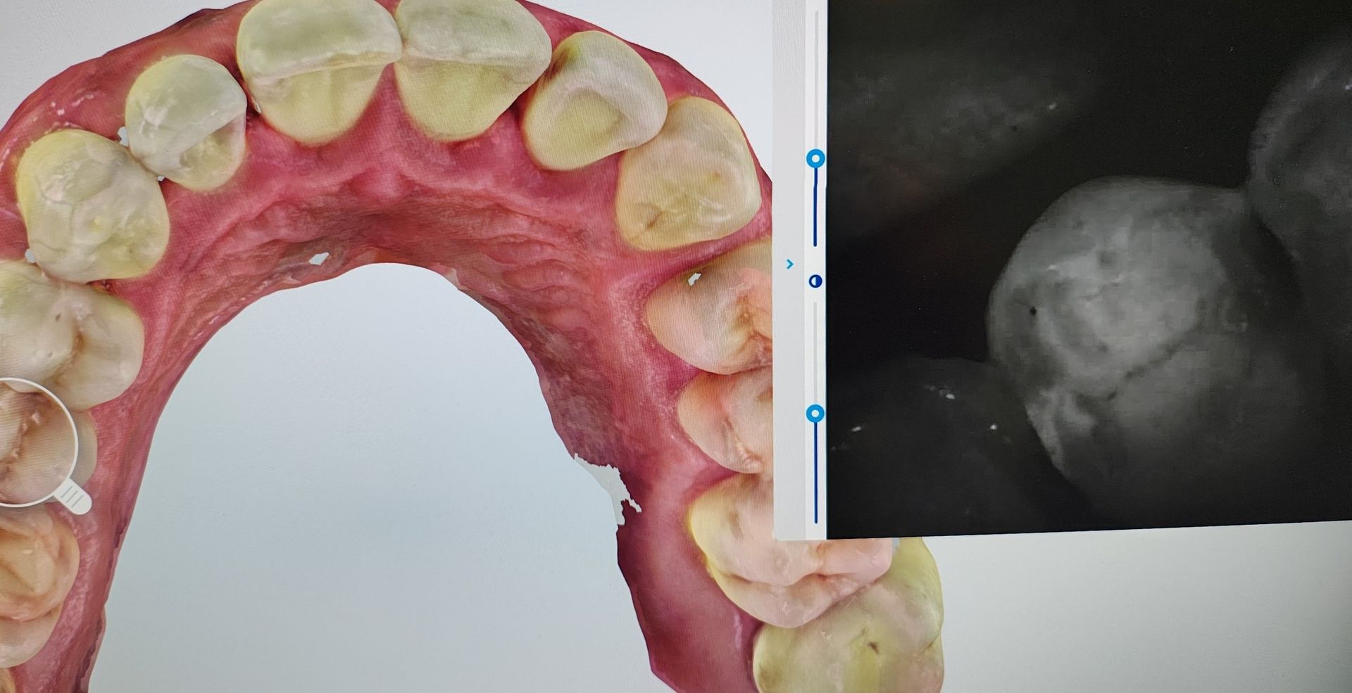 Modelli dentali e radiografia di un dente. Il modello mostra un'arcata dentale superiore. La radiografia è in bianco e nero.
