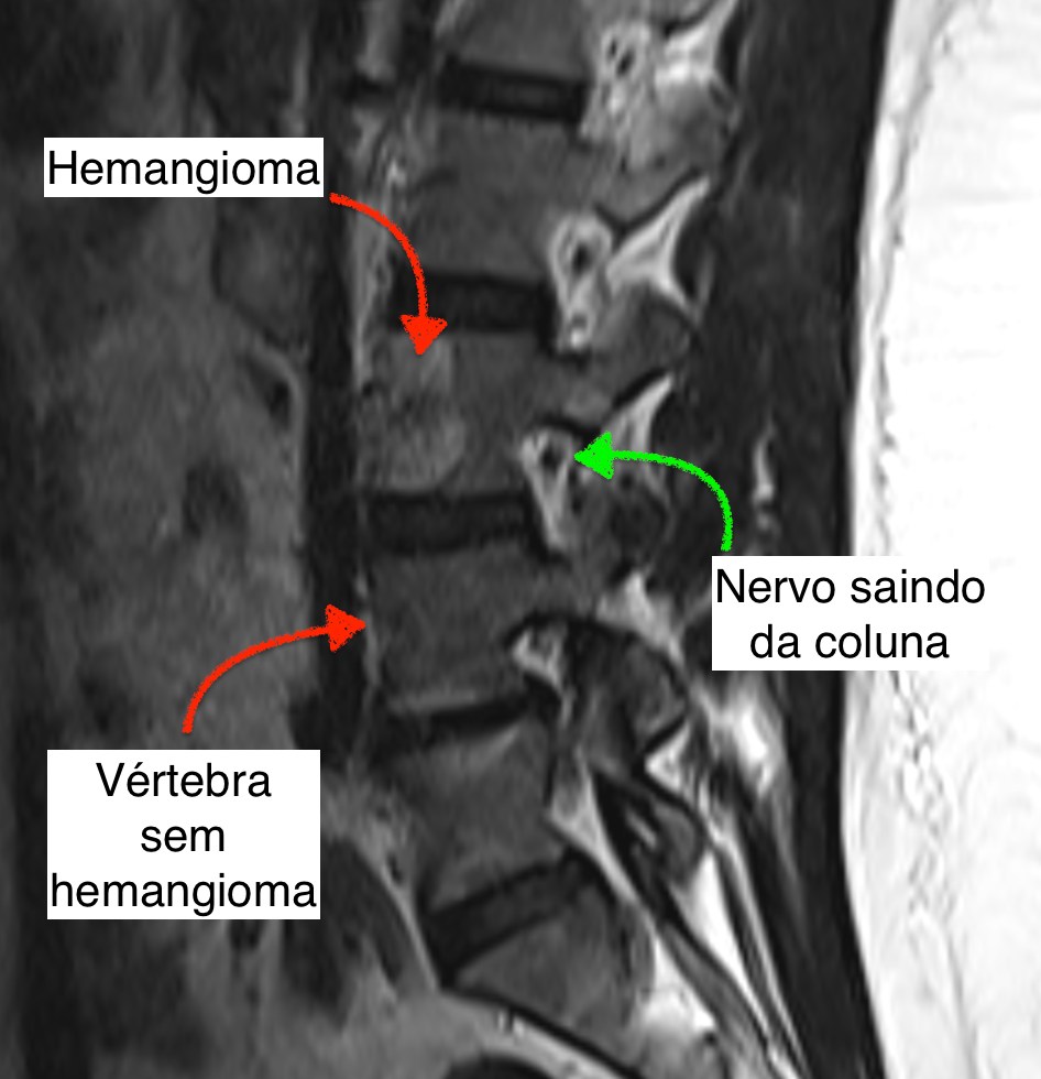 Imagem de ressonância magnética da coluna lombar mostrando um hemangioma vertebral, com destaque para a vértebra afetada e a saída do nervo espinhal.