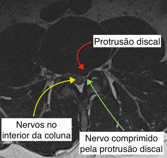 Imagem de ressonância magnética mostrando disco com protrusão discal reduzindo o espaço onde os nervos passam na coluna e comprimindo um nervo.