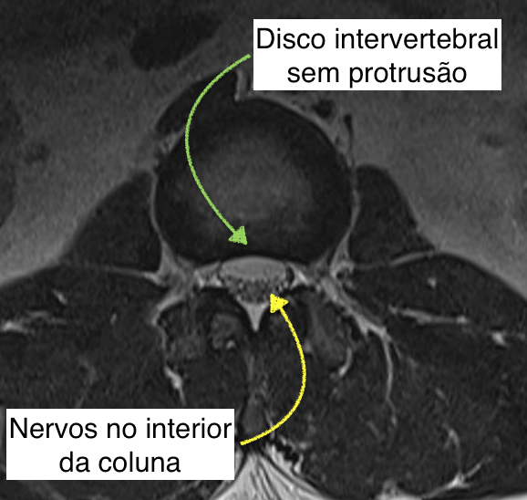 Imagem de ressonância magnética de coluna lombar em corte axial (olhando a coluna de cima) mostrando um disco normal e canal lombar sem compressões.