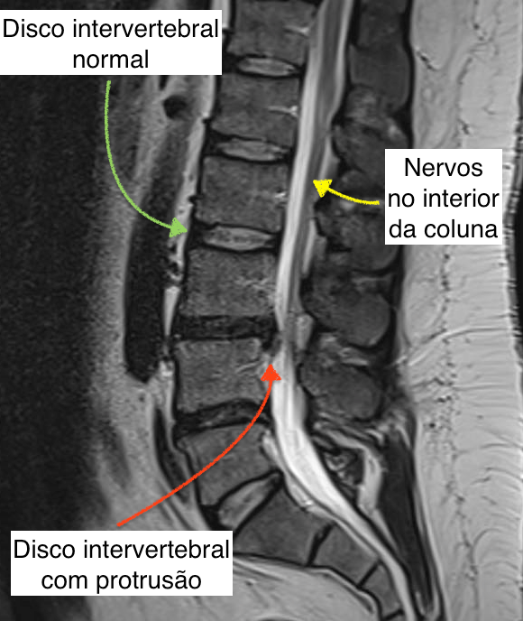 Imagem de ressonância magnética mostrando um corte sagital com disco intervertebral normal e um disco com protrusão discal.