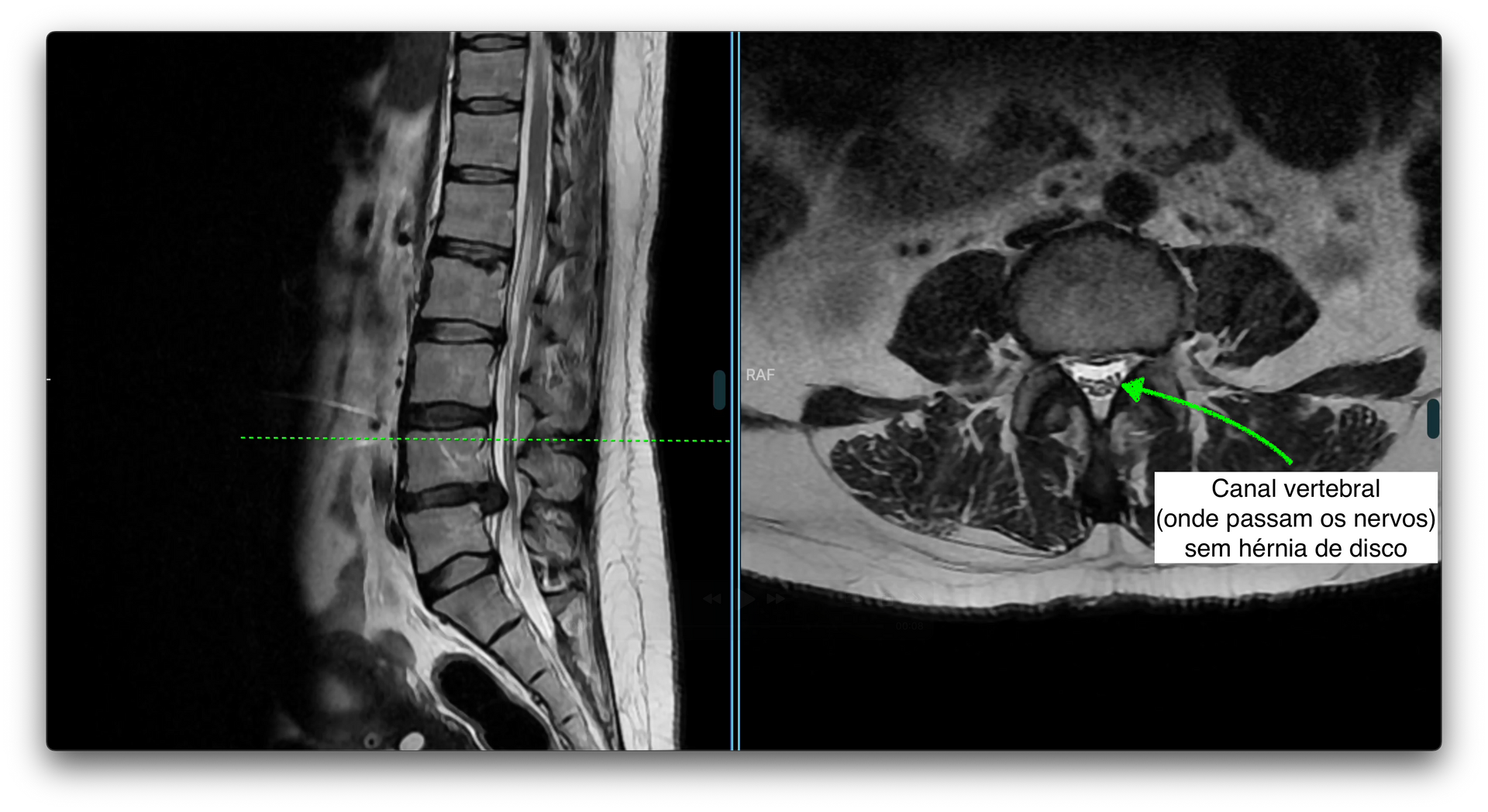 Ressonância magnética de coluna lombar mostrando hérnia discal L4-5 na imagem da esquerda. Na direita, corte axial sem alterações.