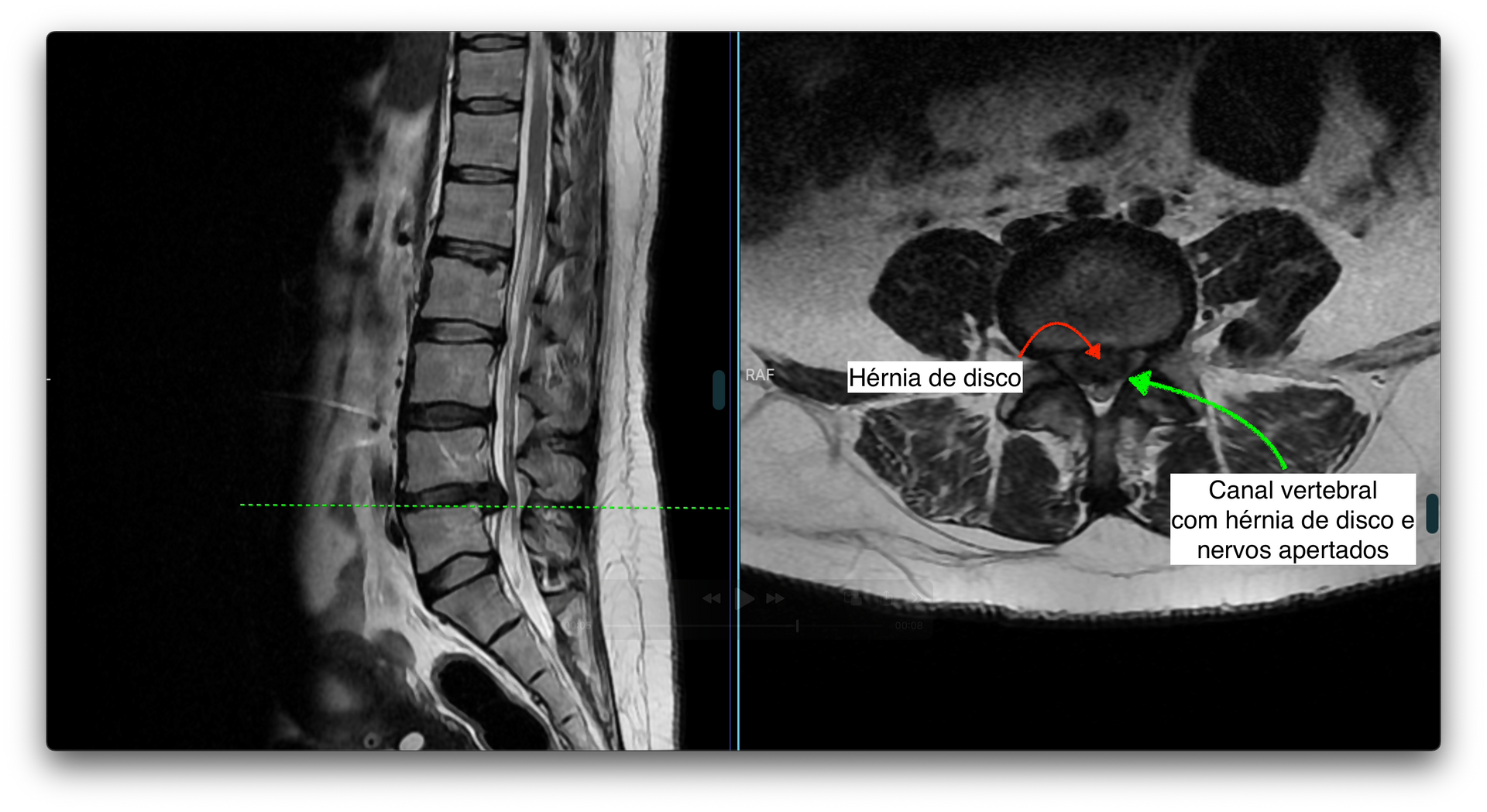 Ressonância magnética de coluna lombar com um corte sagital e corte axial mostrando hérnia de disco L4-5 com estenose grave do canal lombar