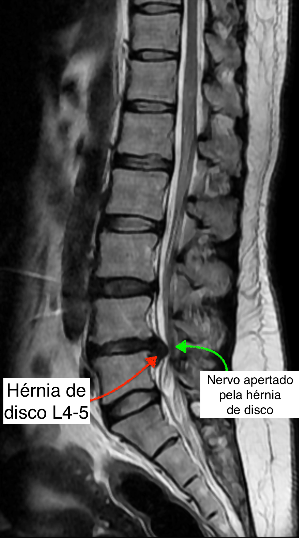 Ressonância magnética de coluna lombar com hérnia de disco L4-5