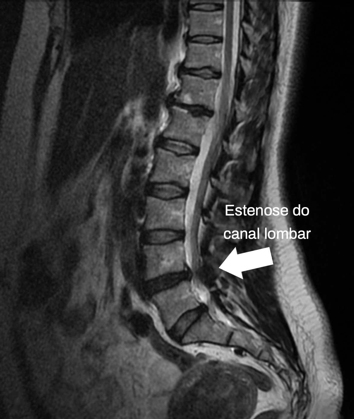 Estenose espinhal lombar