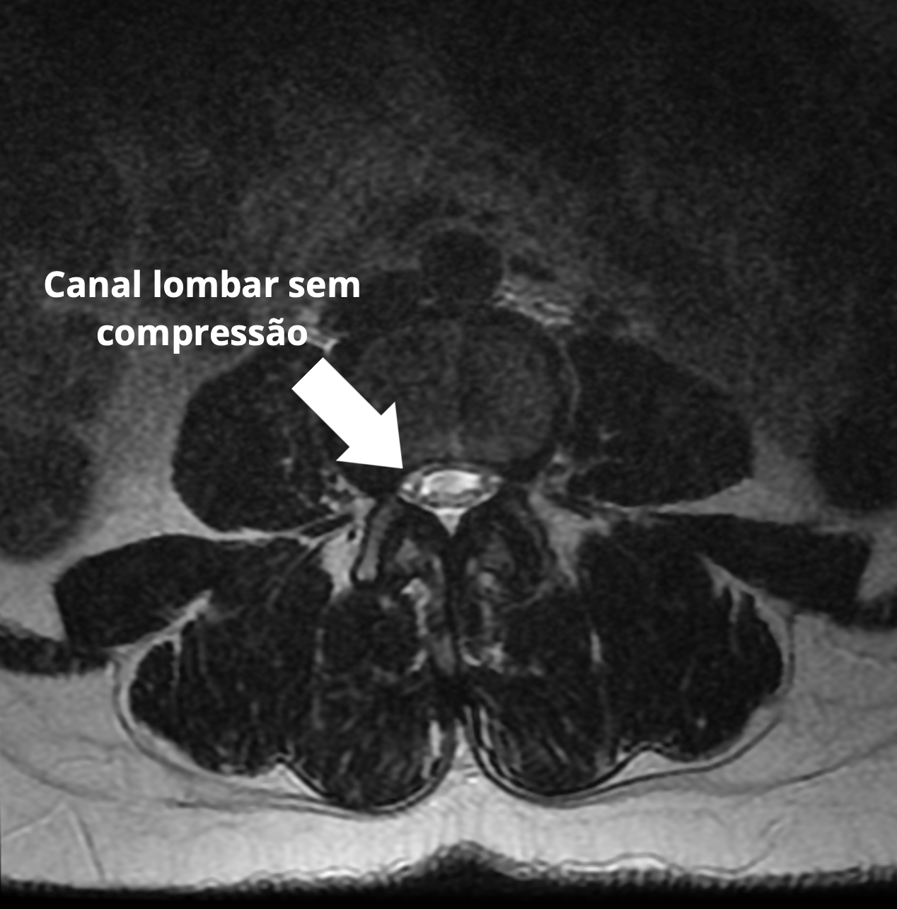 Canal lombar sem compressão