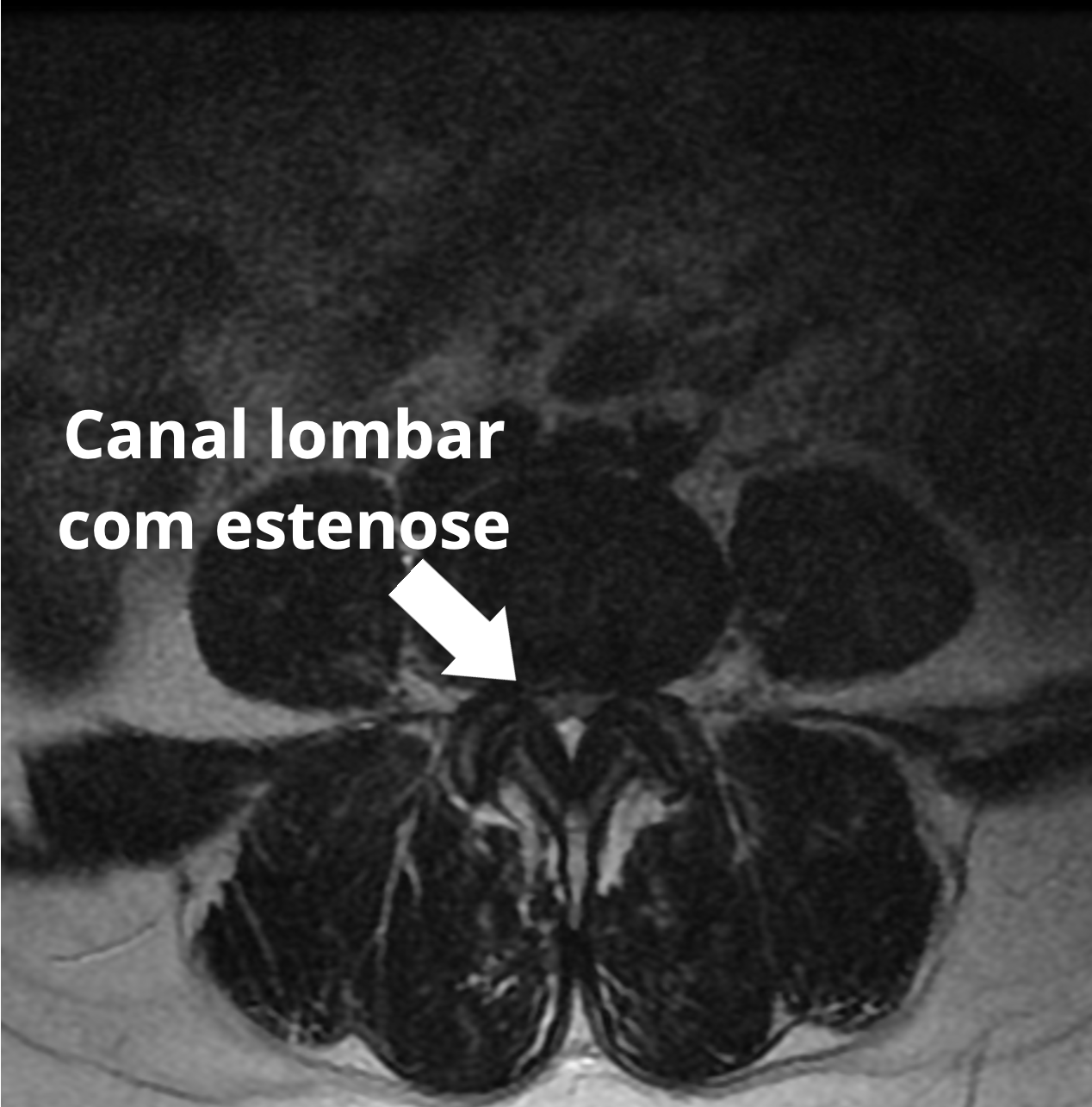 Estenose de canal lombar