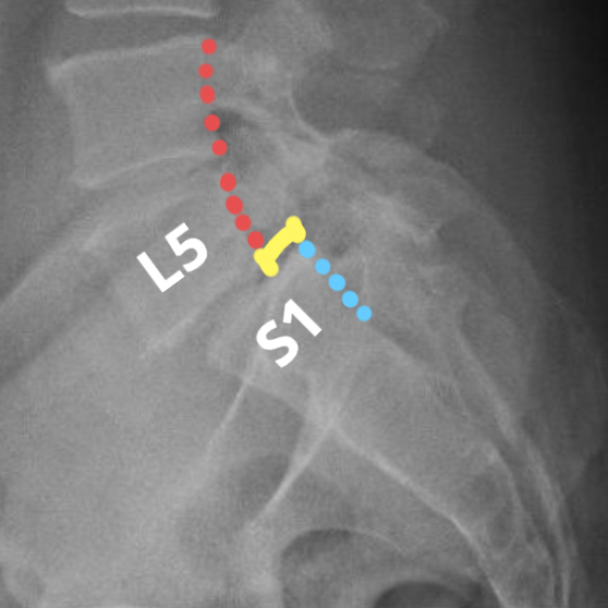 Radiografia de coluna lombar mostrando espondilolistese L5-S1, ou seja, o deslizamento da última vértebra lombar (L5) sobre a primeira vértebra sacral (S1). Observe o alinhamento da vértebra L5 com a vértebra acima (em vermelho) e a distância (em amarelo) da linha atrás da vértebra L5 em relação a linha atrás da vértebra S1 (em azul).