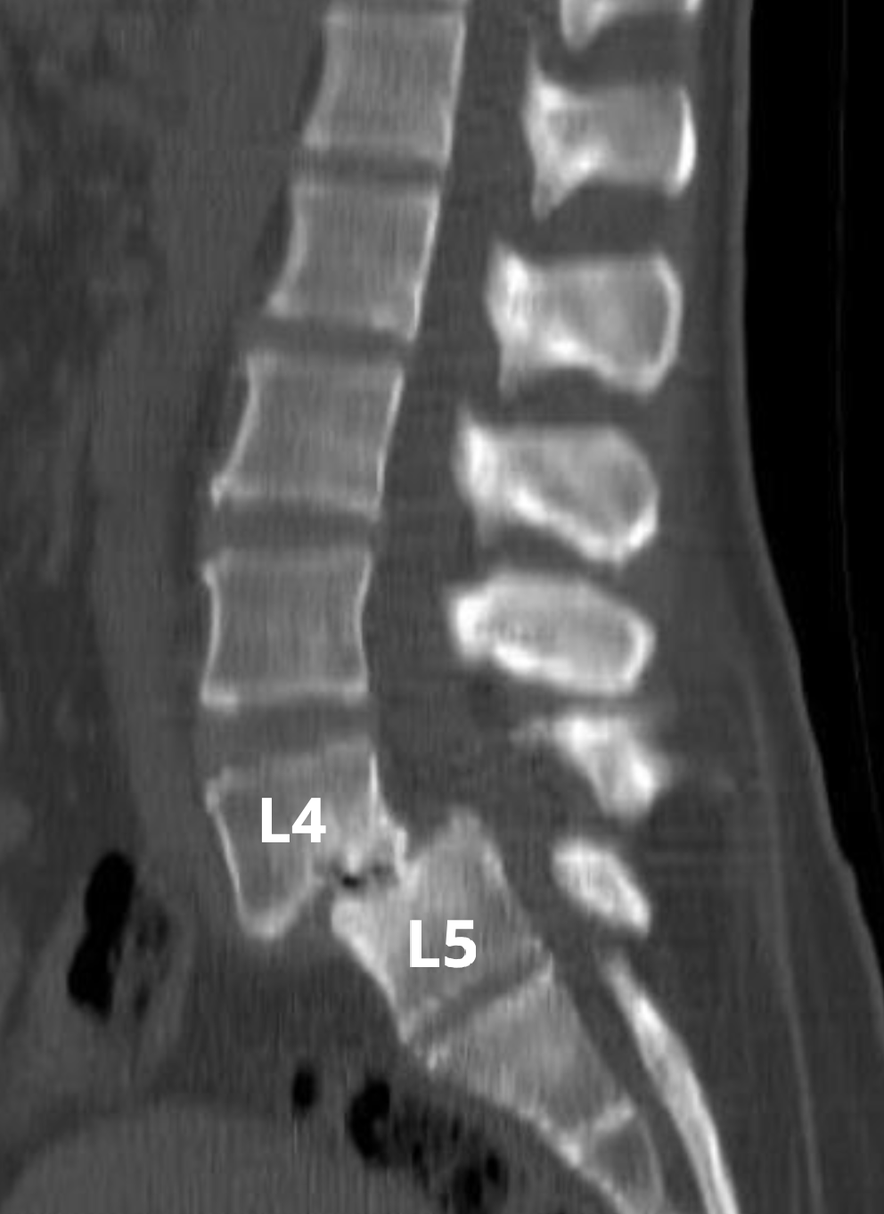 Tomografia computadorizada de coluna lombar mostrando espondilolistese entre a quarta (L4) e quinta (L5) vértebras lombares.