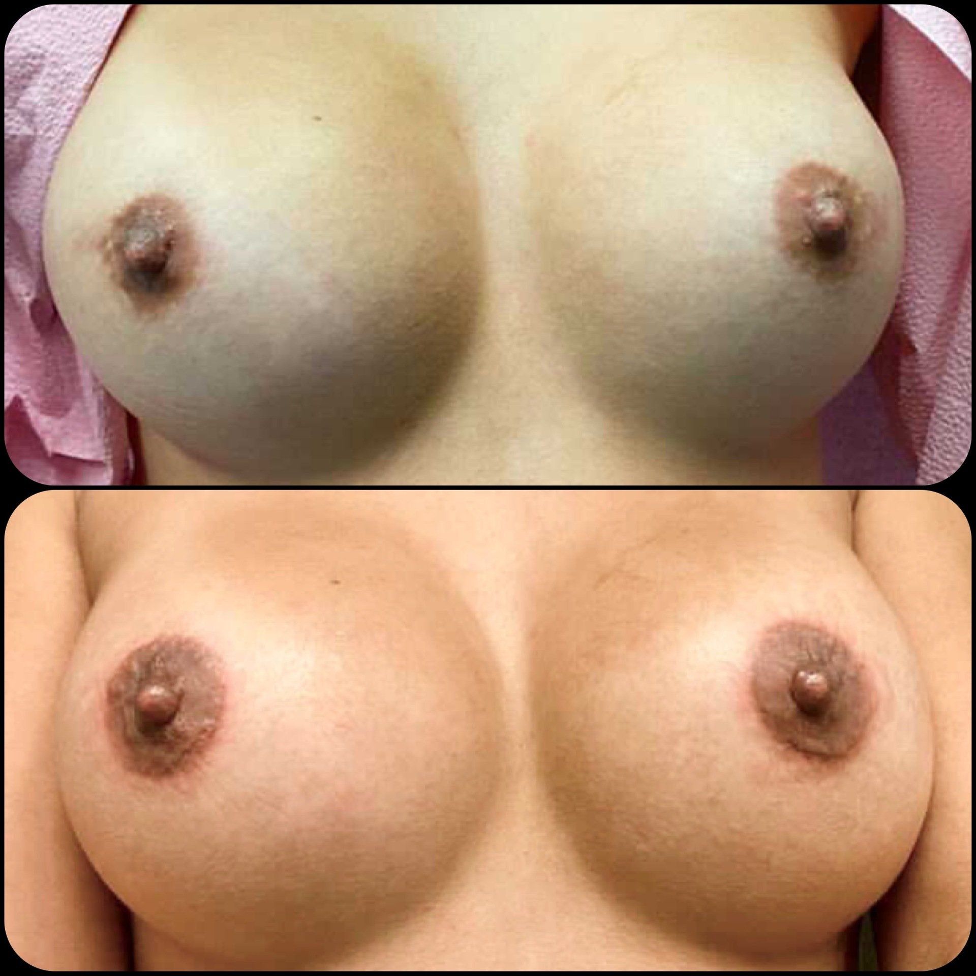 Before and after, areola symmetry restoration