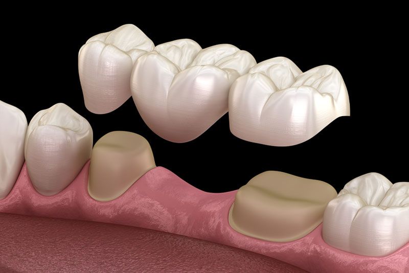 Dentures, crowns and bridges — Hamilton, Oh — Clements Family Dentistry