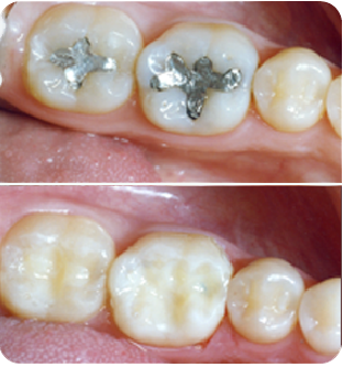 Tooth filling — Hamilton, Oh — Clements Family Dentistry