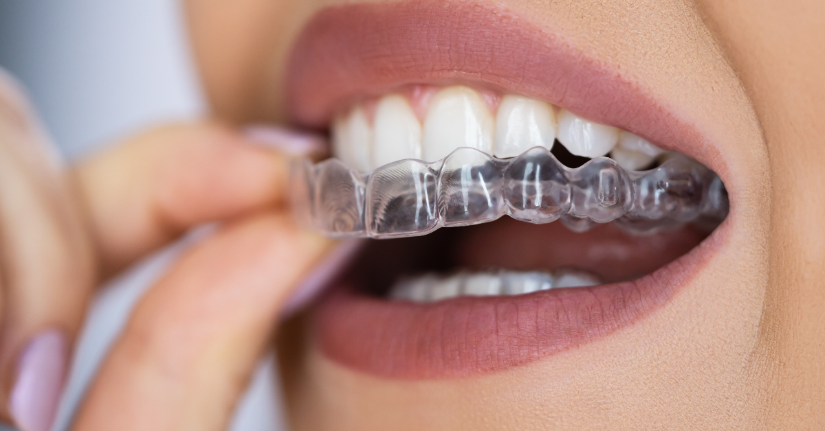 Uma mulher está colocando um aparelho transparente nos dentes.