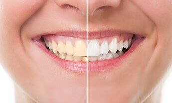Dental Teeth Whitening — Dental in New Haven, MI