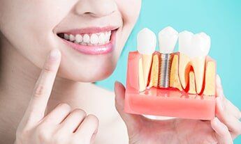 Dental Teeth Implants — Dental in New Haven, MI