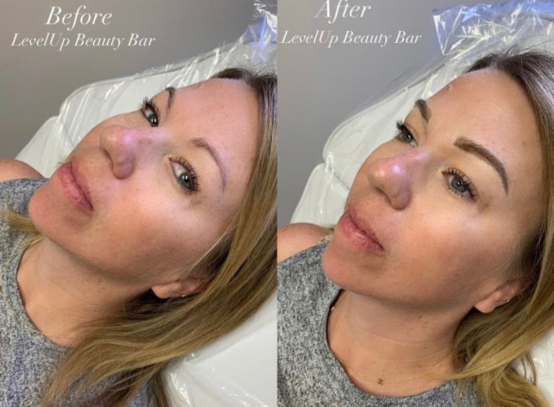 A before and after photo of a woman with a nose surgery.