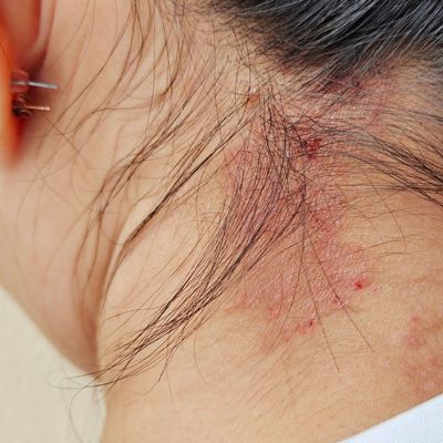 Red, irritated skin allergic reaction on the back of a person's neck near the hairline.