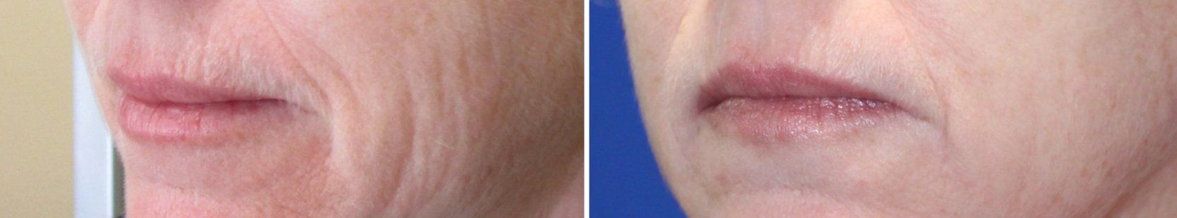Skin Tightening Treatments NYC Before and After