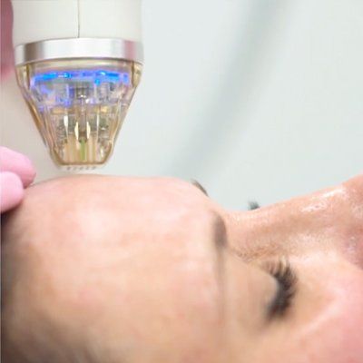 How Collagen Induction Therapy Works